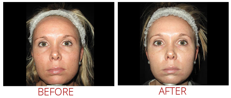 Collagen P.I.N. Before and After