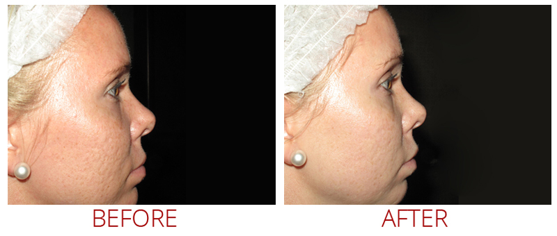 Collagen P.I.N. Before and After