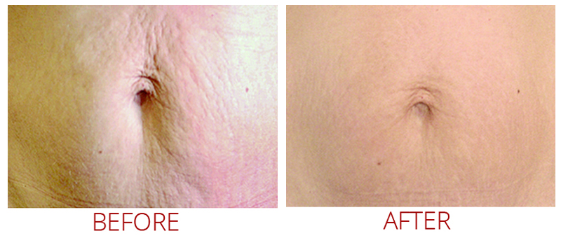 Collagen P.I.N. Before and After